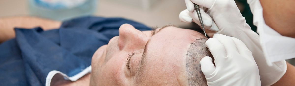 Man hair transplant