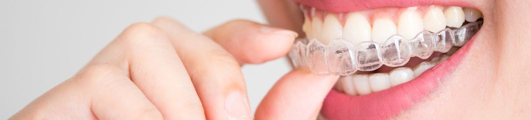 Dekking van een tandverzekering - FAQ